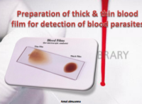 تحضير غشاء دموي سميك ورقيق للكشف عن طفيليات الدم